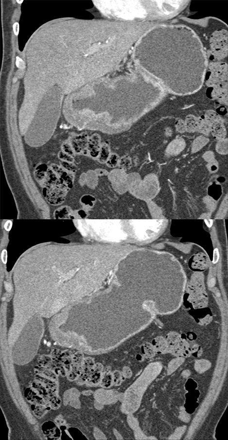 B-Cell Lymphoma Stomach as Incidental Finding (suspect adenoca stomach)