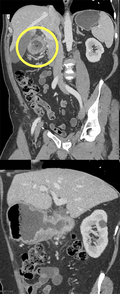 B-Cell Lymphoma Stomach as Incidental Finding (suspect adenoca stomach)