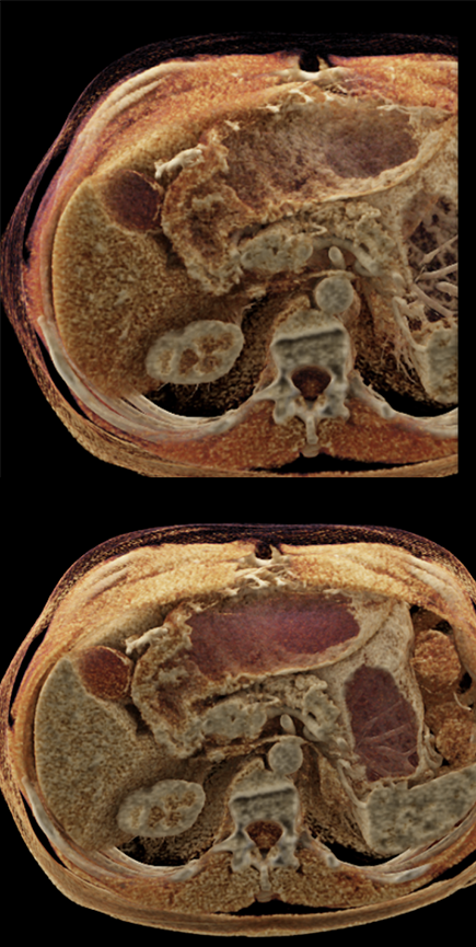 B-Cell Lymphoma Stomach as Incidental Finding (suspect adenoca stomach)