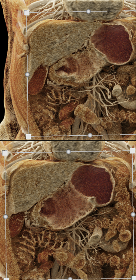 B-Cell Lymphoma Stomach as Incidental Finding (suspect adenoca stomach)