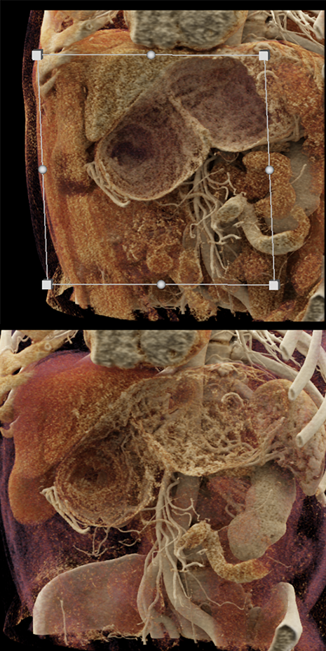 B-Cell Lymphoma Stomach as Incidental Finding (suspect adenoca stomach)