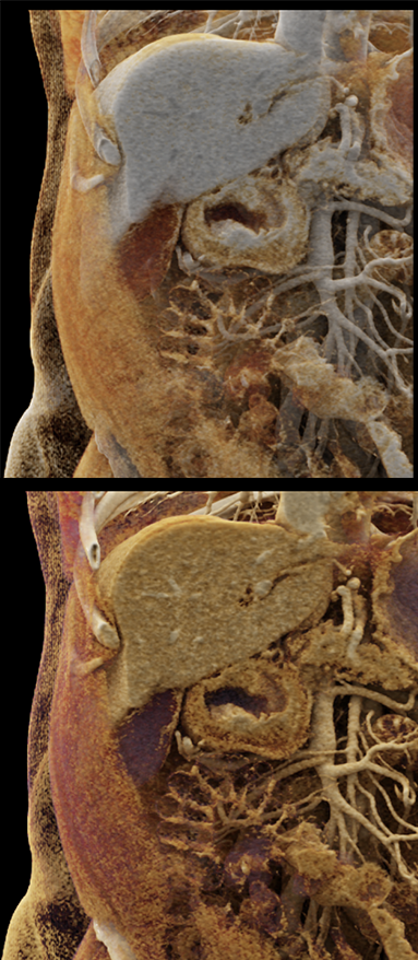 B-Cell Lymphoma Stomach as Incidental Finding (suspect adenoca stomach)