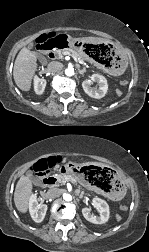 Gastric Lymphoma Presented as GI Bleed