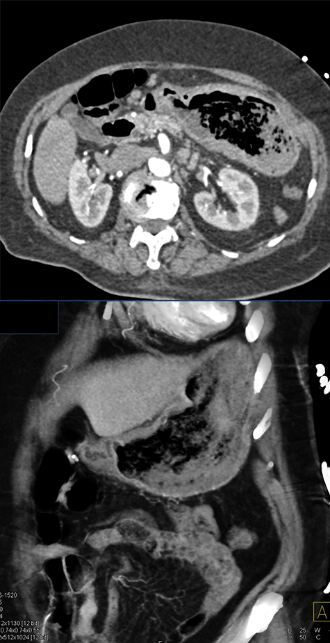 Gastric Lymphoma Presented as GI Bleed