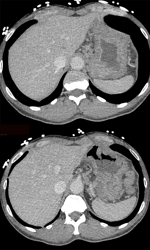 B Cell Gastric Lymphoma with Ulcers (Original Path neg)