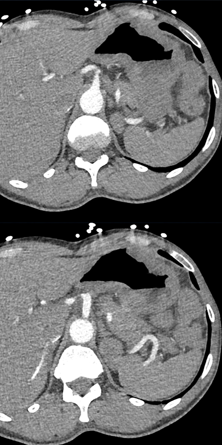 B Cell Gastric Lymphoma with Ulcers (Original Path neg)