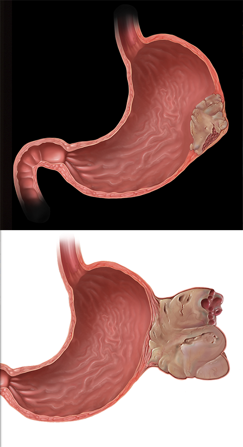 Gastric Malignancies