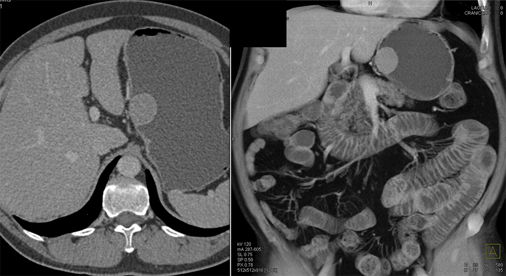 GIST Tumor