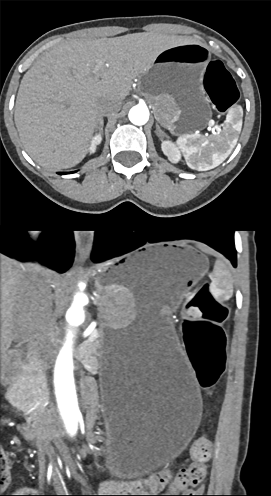 Gastric GIST Tumor