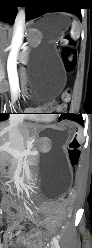 Gastric GIST Tumor