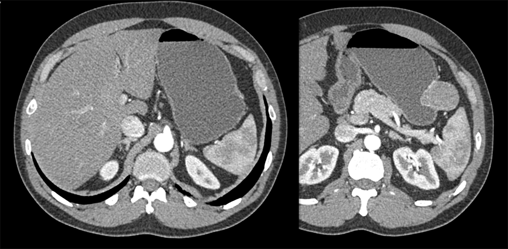 GIST Stomach