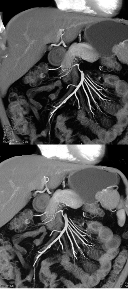 GIST Stomach