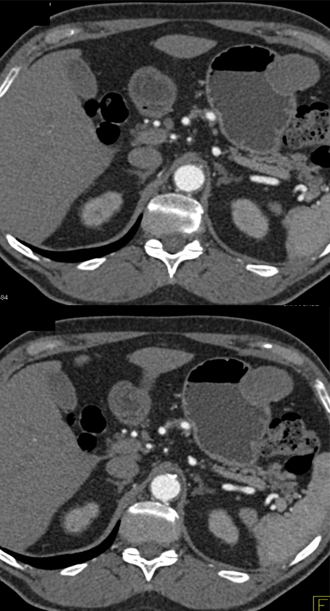 Gastric GIST Tumor