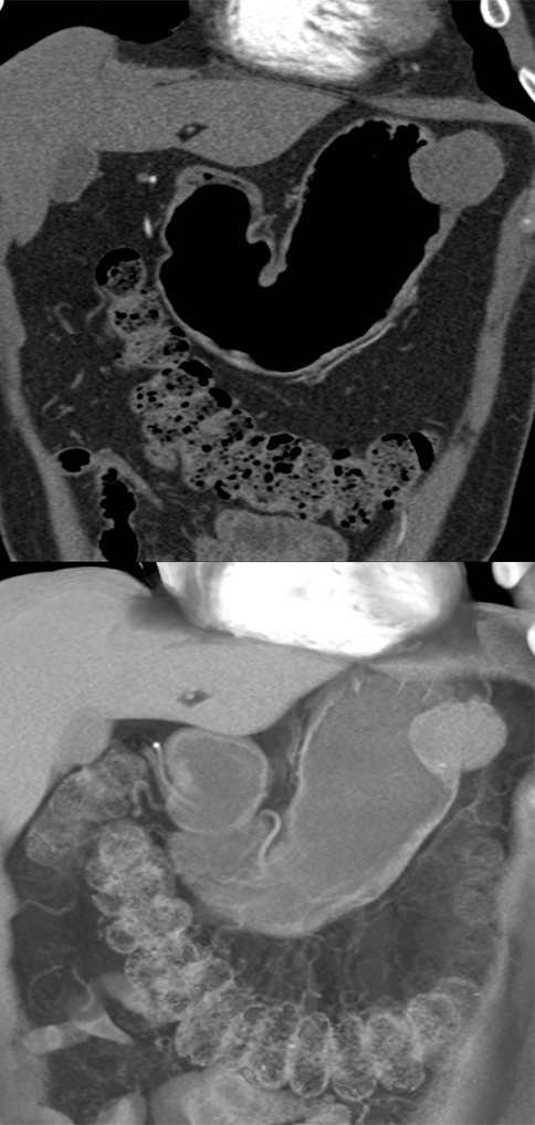 Gastric GIST Tumor