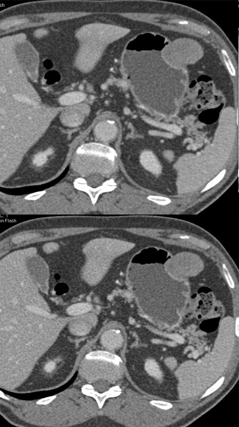 Gastric GIST Tumor