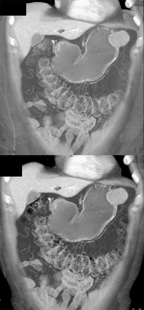 Gastric GIST Tumor