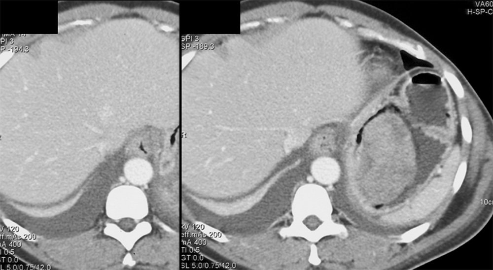 GIST Tumor