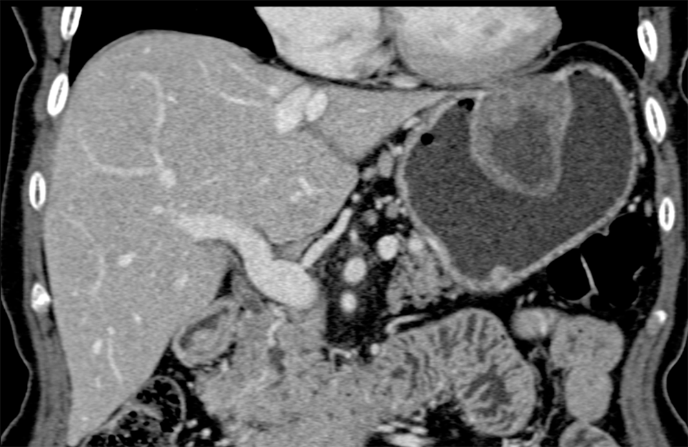 Gastric GIST Tumor