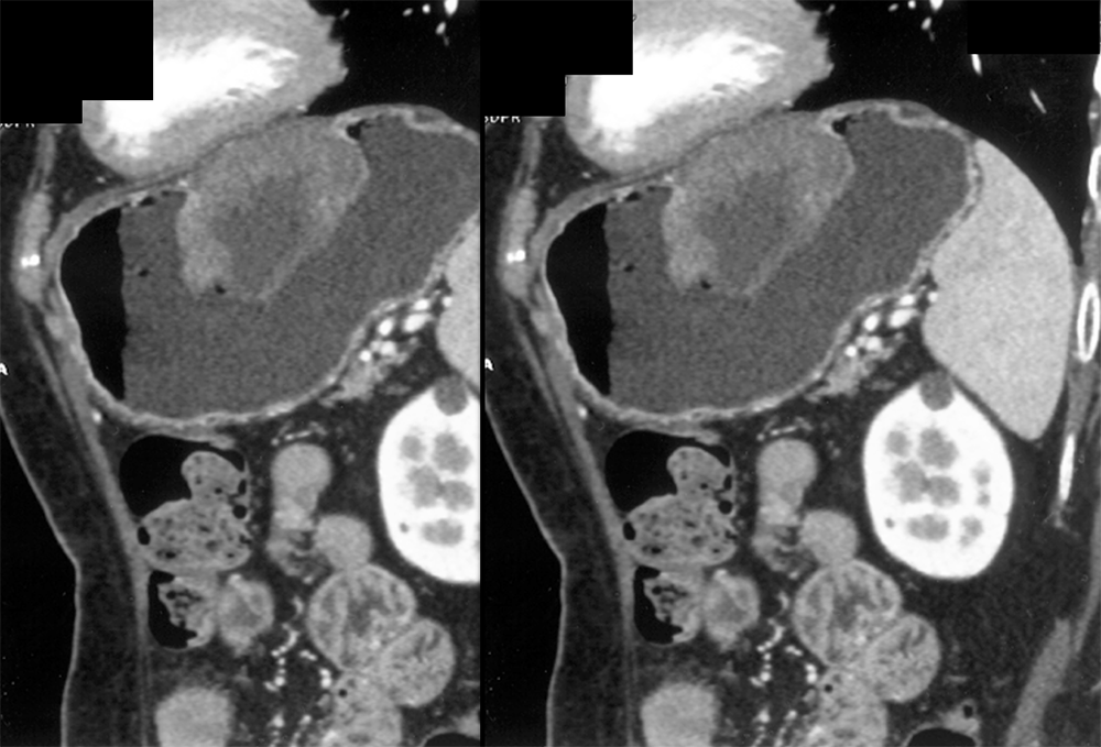 Gastric GIST Tumor