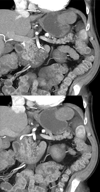 Gastric GIST Tumor