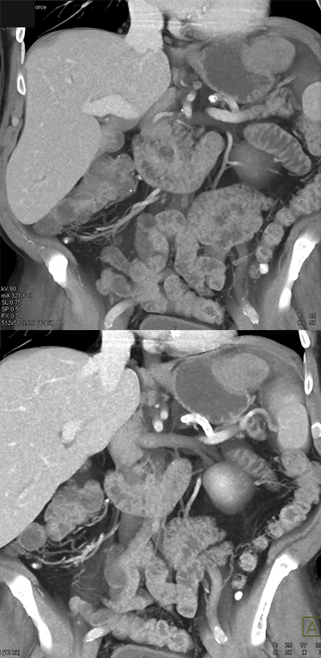 Gastric GIST Tumor