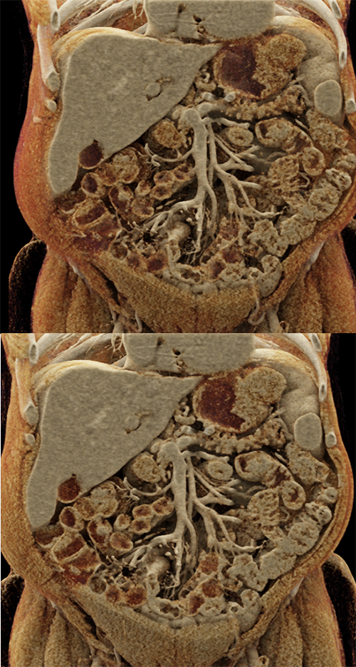 Gastric GIST Tumor