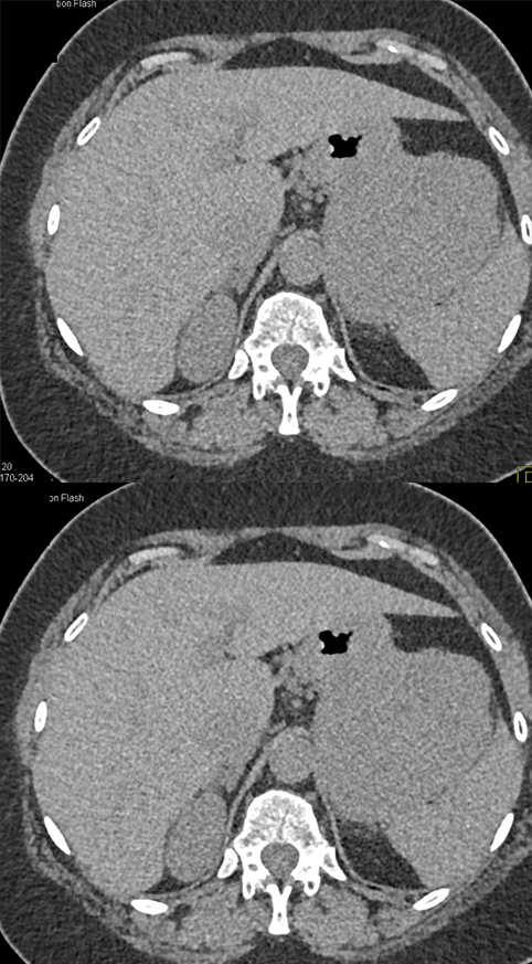 Gastric GIST Tumor Presented as an Adrenal Mass