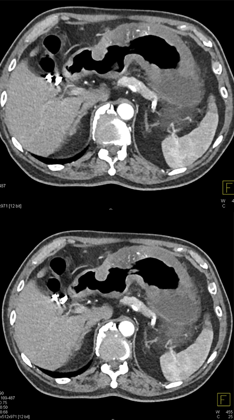 Gastric Adenocarcinoma in an ER Patient 