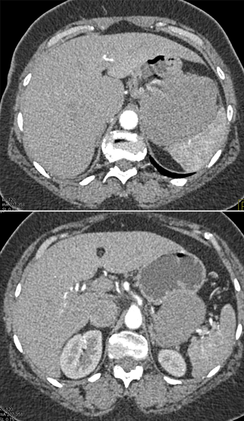 Gastric GIST Tumor Presented as an Adrenal Mass