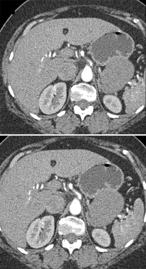 Gastric GIST Tumor Presented as an Adrenal Mass