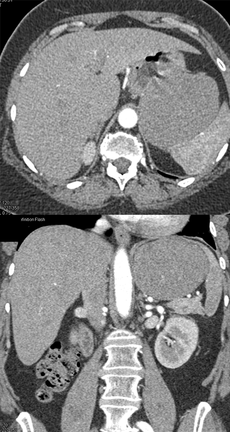 Gastric GIST Tumor Presented as an Adrenal Mass