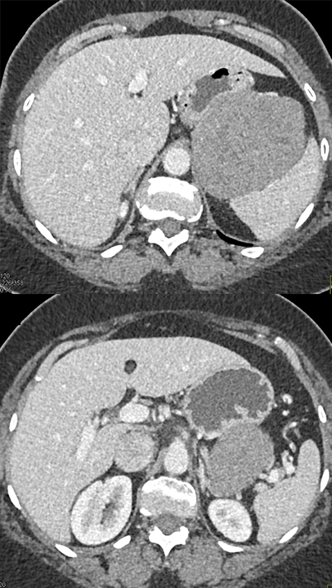 Gastric GIST Tumor Presented as an Adrenal Mass