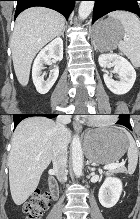 Gastric GIST Tumor Presented as an Adrenal Mass