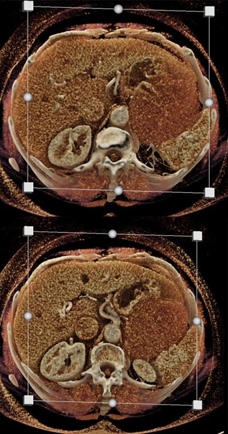 Gastric GIST Tumor Presented as an Adrenal Mass