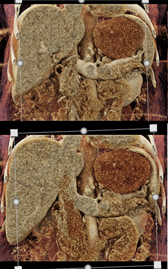 Gastric GIST Tumor Presented as an Adrenal Mass