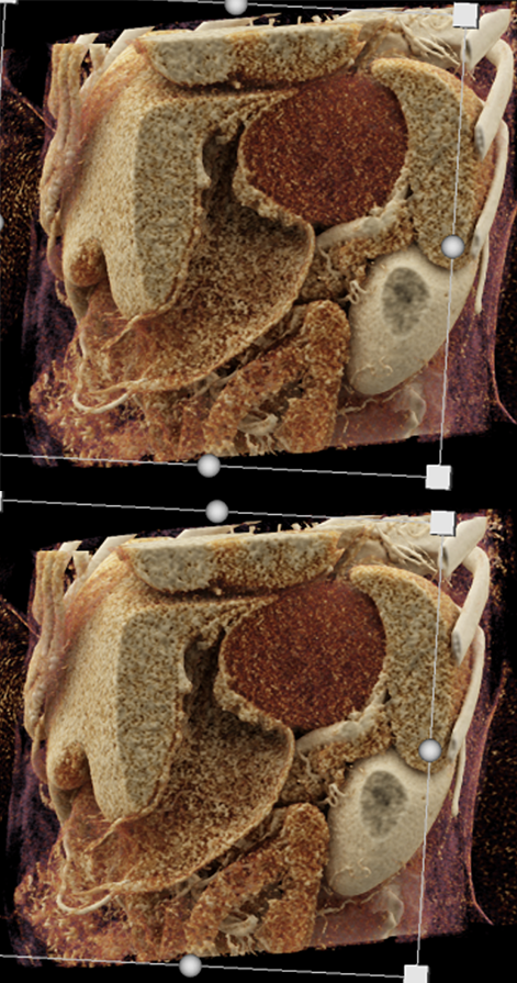 Gastric GIST Tumor Presented as an Adrenal Mass