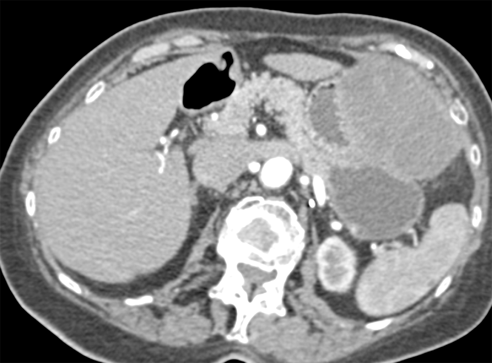 Gastric GIST