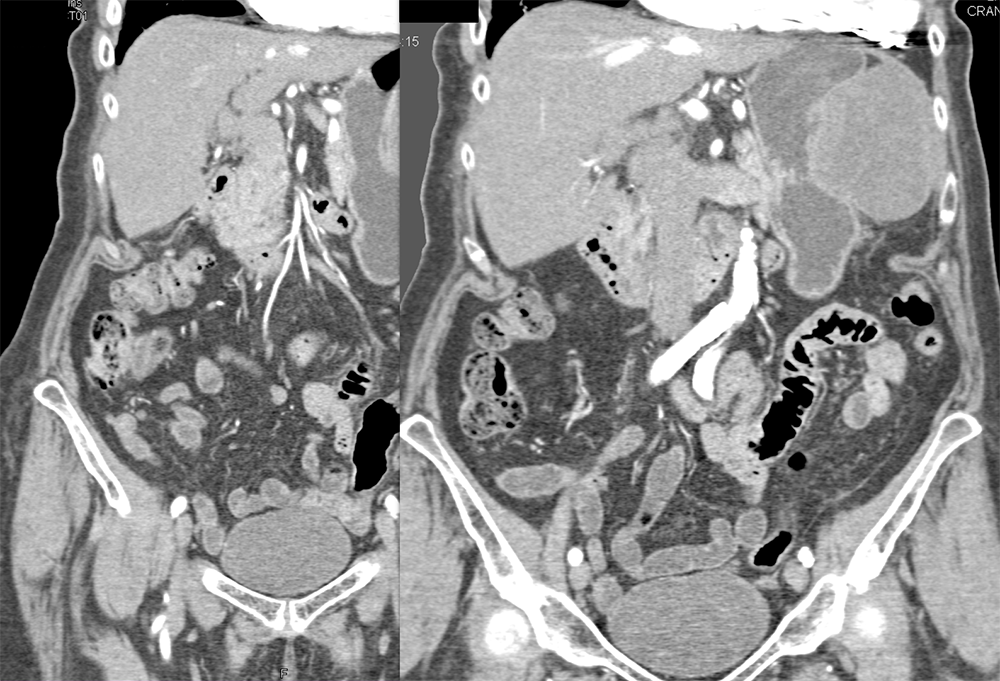 Gastric GIST