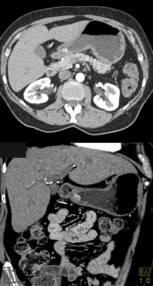 GI Bleed due to a Gastric Ulcer in a Patient with H. pylori Gastritis