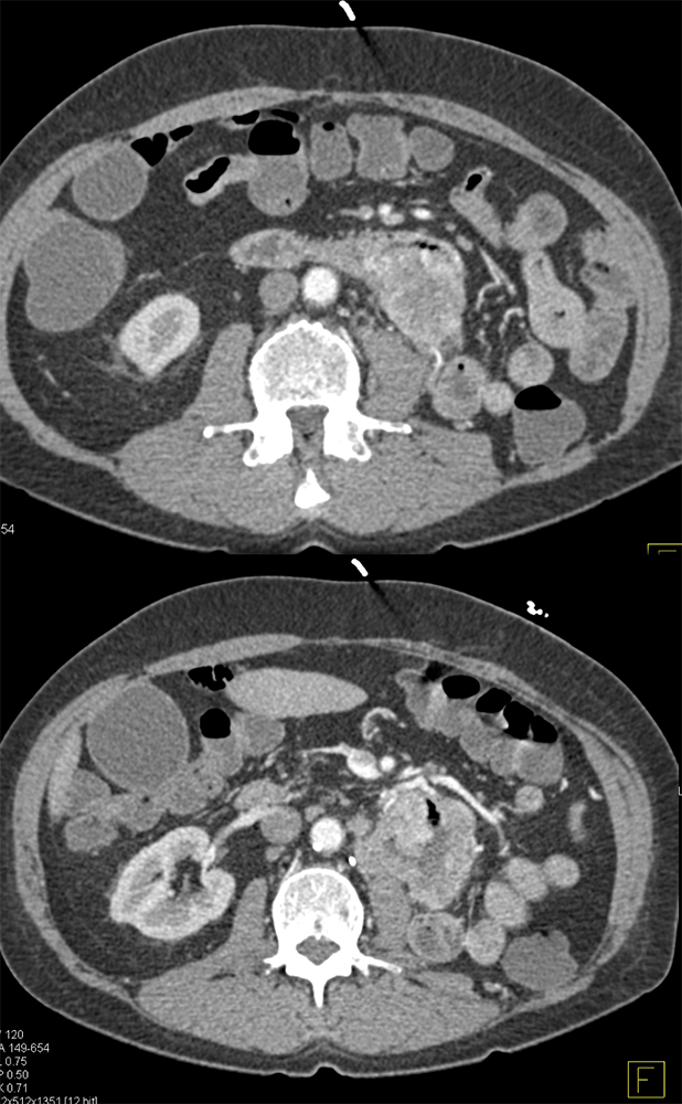 CT of GI Bleed