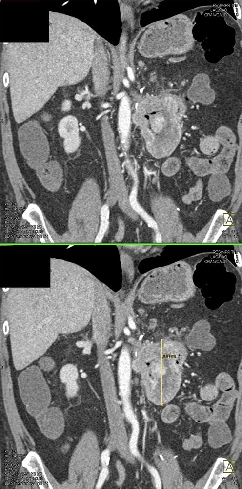 CT of GI Bleed