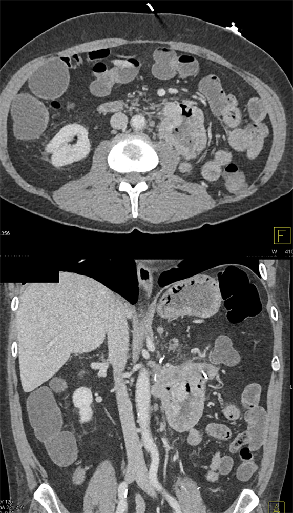 CT of GI Bleed