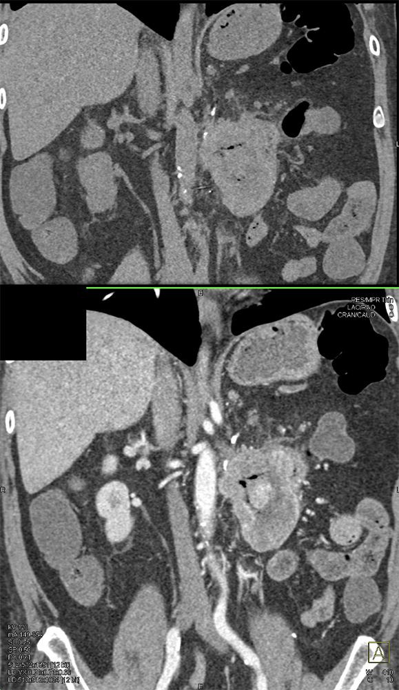 Metastatic RCC to Duodenum