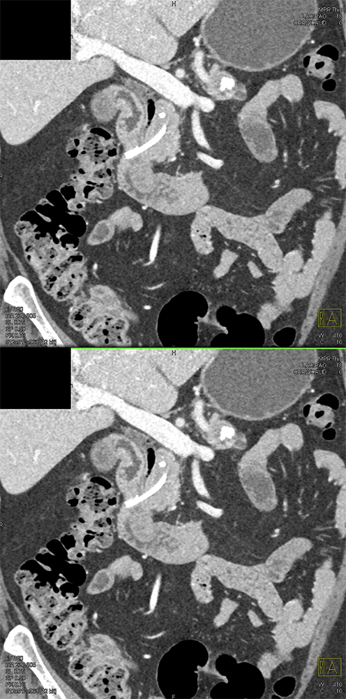 CT of GI Bleed