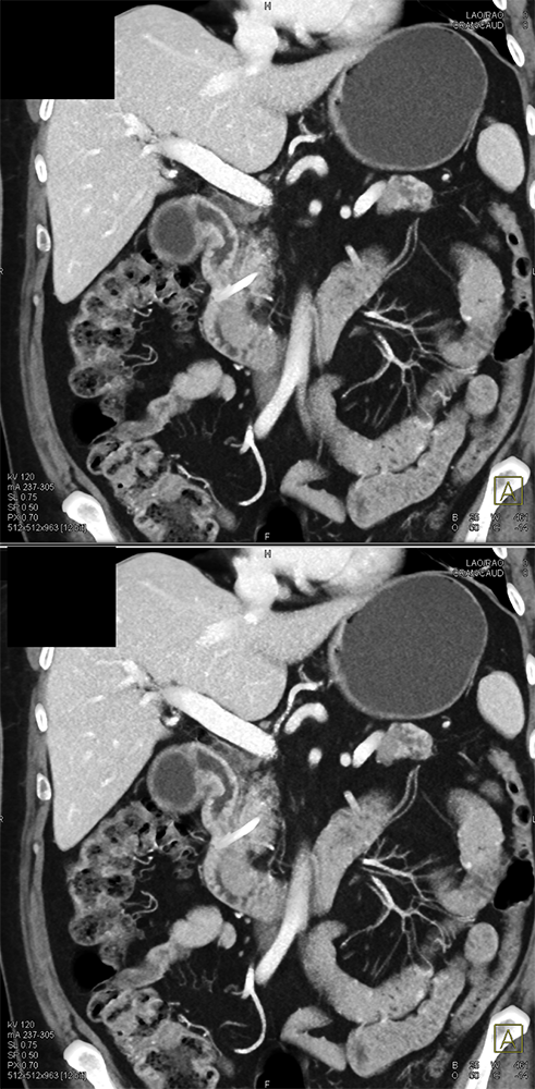 CT of GI Bleed