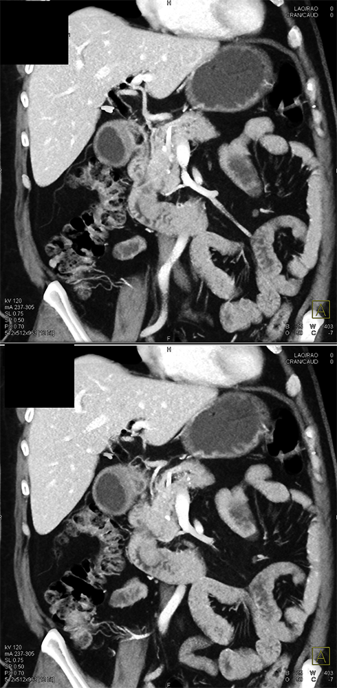 CT of GI Bleed