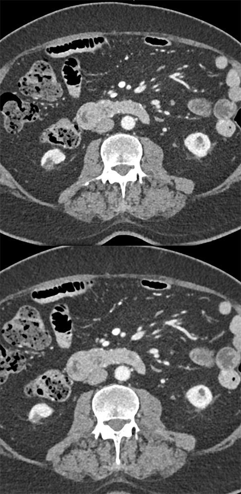 Lymphangioma Duodenum