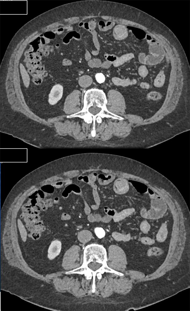 Abdominal Pain and GI Bleed