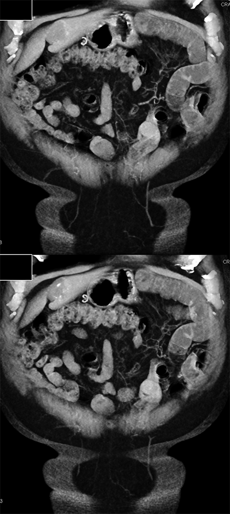 CT of GI Bleed