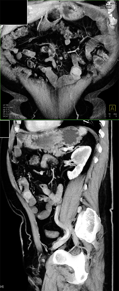 CT of GI Bleed